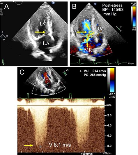 normal Lv outflow gradient